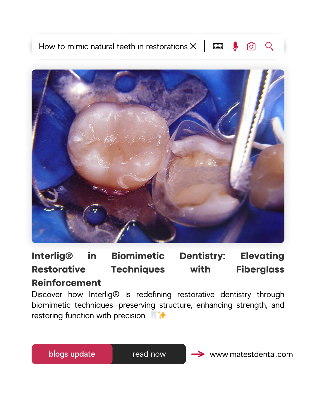 Interlig® in Biomimetic Dentistry: Elevating Restorative Techniques with Fiberglass Reinforcement