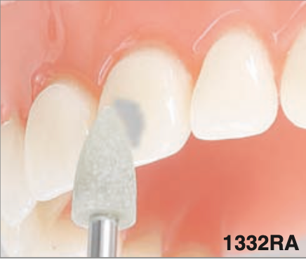 OrthoFlex - Adhesive remover