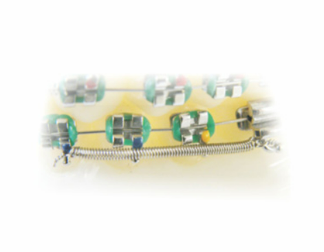 Orthodontic Spring CrNi