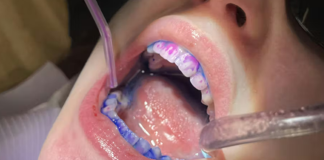 Plaque-D Disclosing Gel