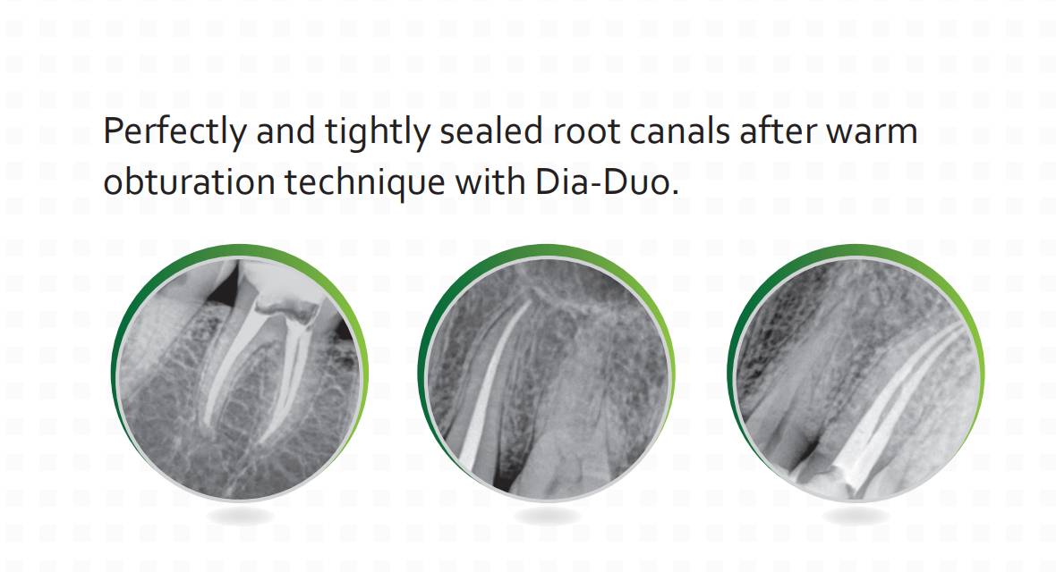 Dia-Duo- advanced cordless obturation system