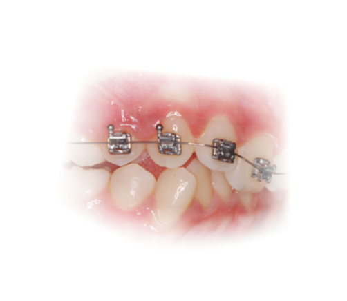 Archwire Superelastic "Ultra Light" NiTi Round Ø0,25mm (.010")