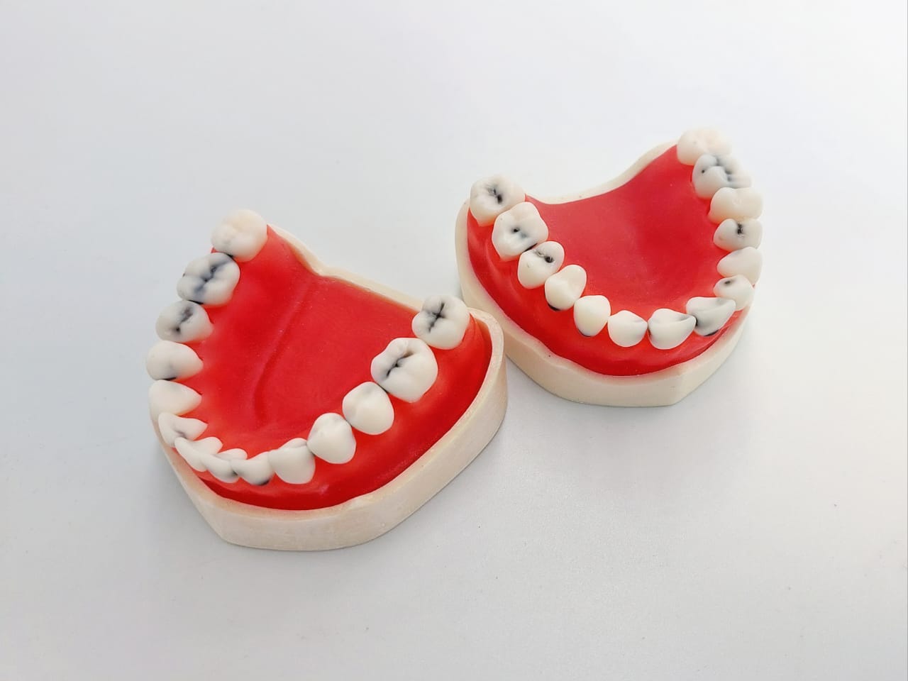 Full jaw dental caries model study- 28 teeth