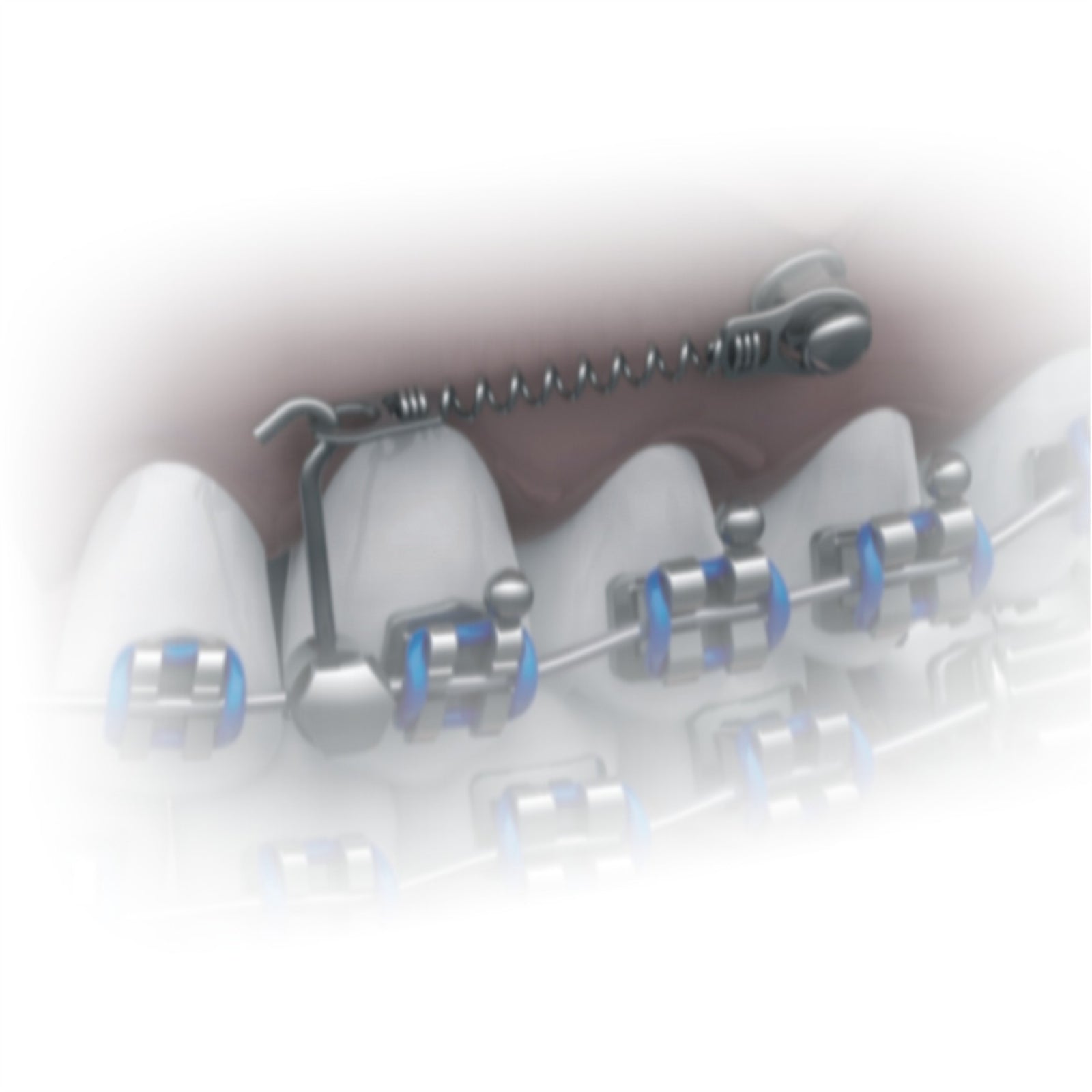 Closed Spring NiTi for Mini Screw