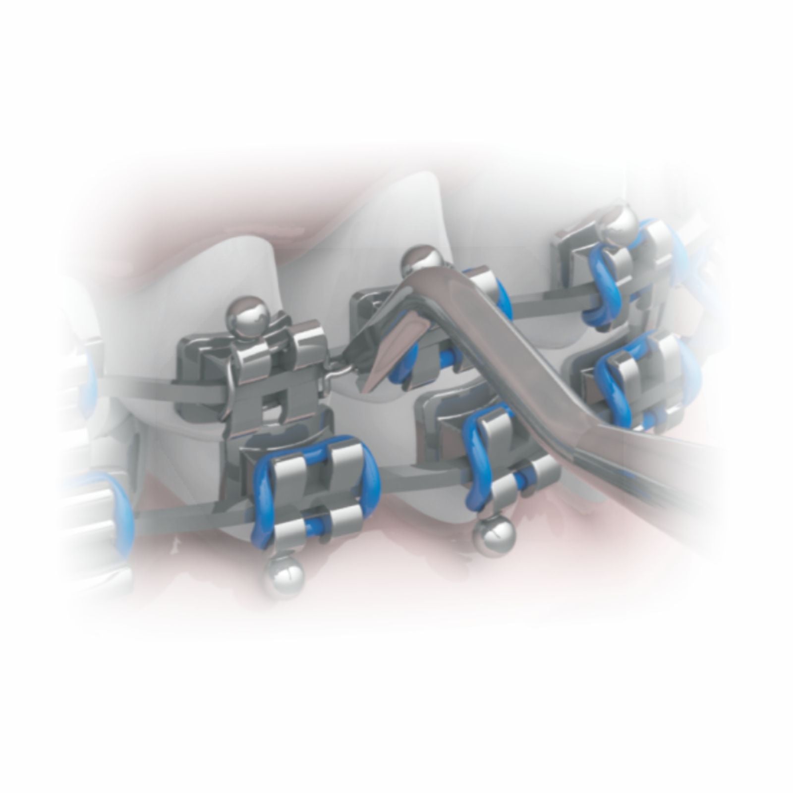 Arm Bending Distal & Ligature Bending