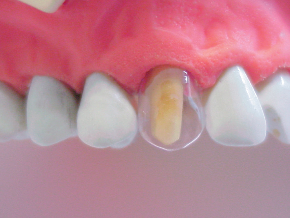 Transparent Crowns For Teeth Reconstruction