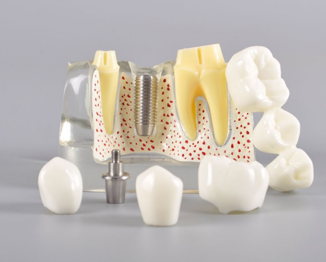 Implant Analysis Model- Transparent Color