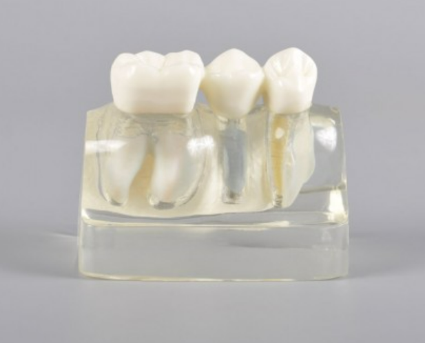 Implant Analysis Model- Transparent Color