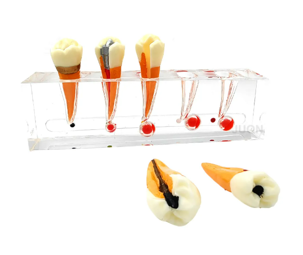 Endodontic Treatment Tooth Model For Dentistry Lab & Patient Education