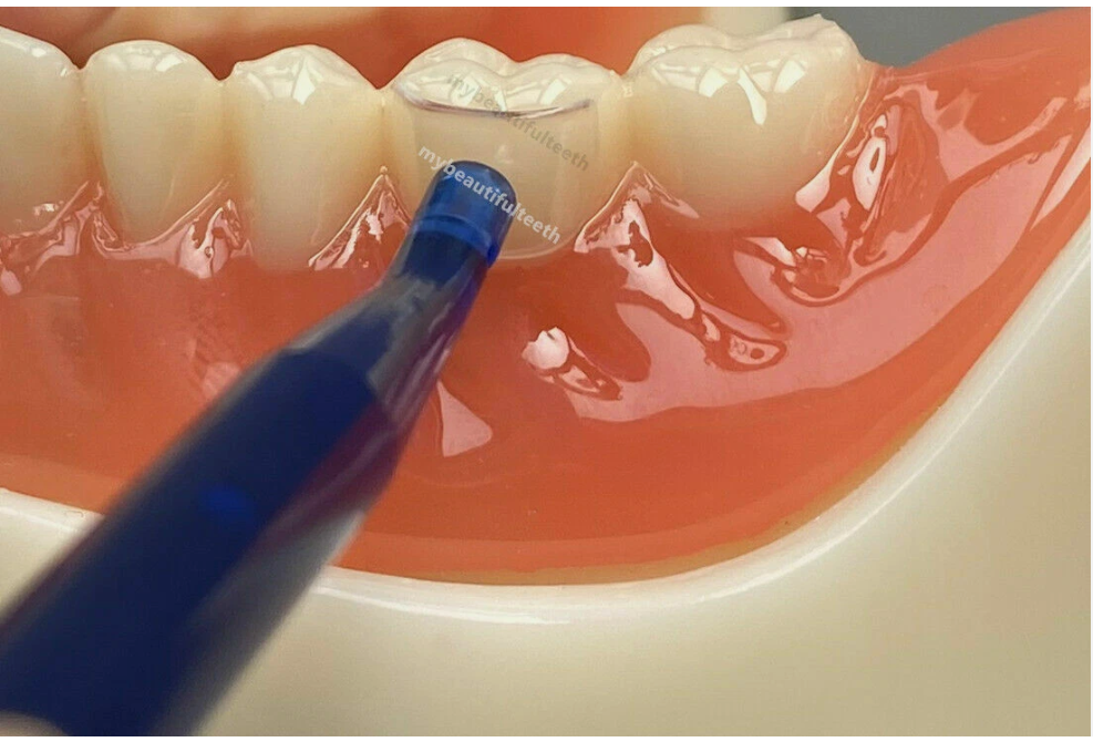Transparent Cervical Matrix Kit