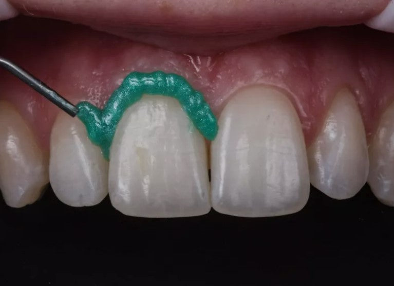 TOP DAM - Light-Curing Gingival Barrier