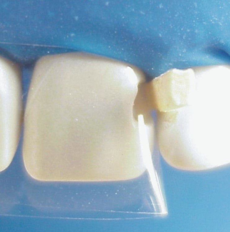 Polyester Matrix Strips
