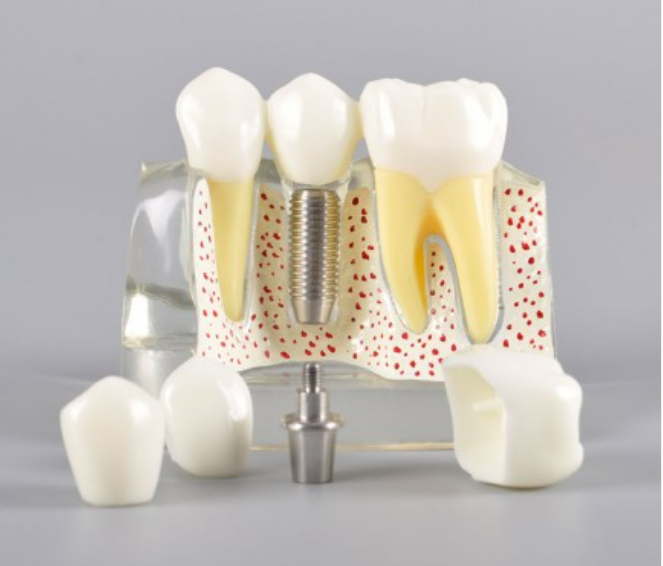 Implant Analysis Model- Transparent Color