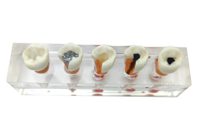 Endodontic Treatment Tooth Model For Dentistry Lab & Patient Education
