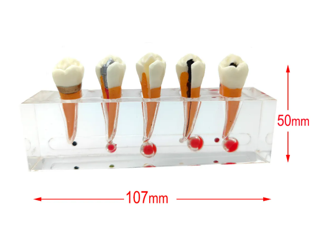Endodontic Treatment Tooth Model For Dentistry Lab & Patient Education