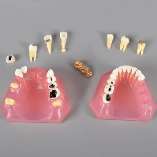 Caries Treatment Model Before & After