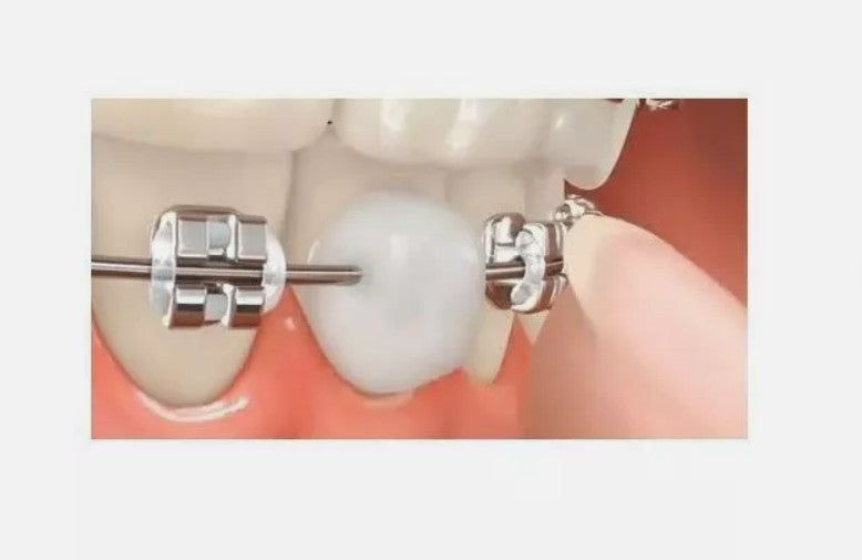 Orthodontic Wax Protection - Mint Flavor