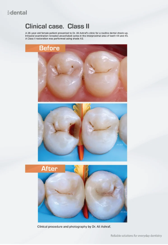 i-Rock - Light Cure Nano Hybrid Composite Based on Zirconium