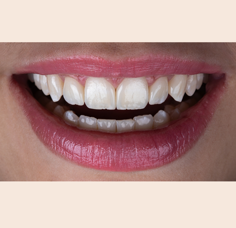 Elóra APS - A Nanohybrid Composite Resin