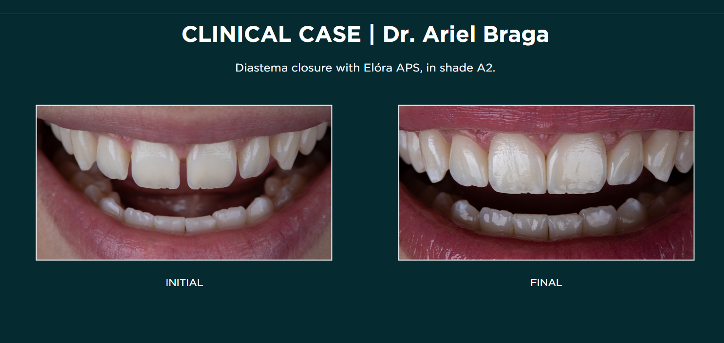 Elóra APS - A Nanohybrid Composite Resin