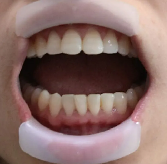 Cheek retractor- (o-type)