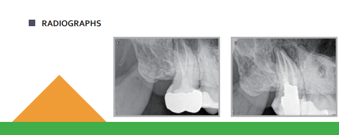 Dia-ProSeal- root canal sealing material