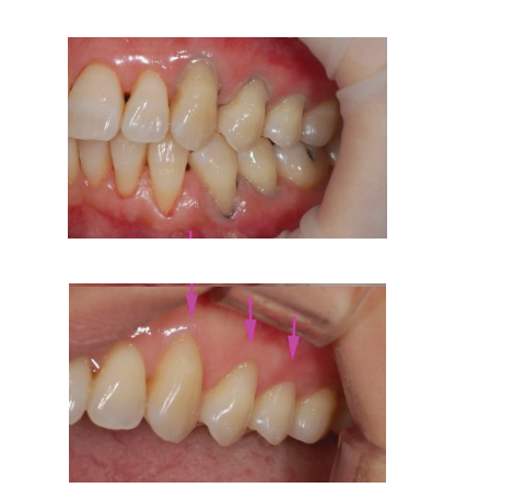 Diafil flow - Light Cured Flowable Restorative Composite Resin