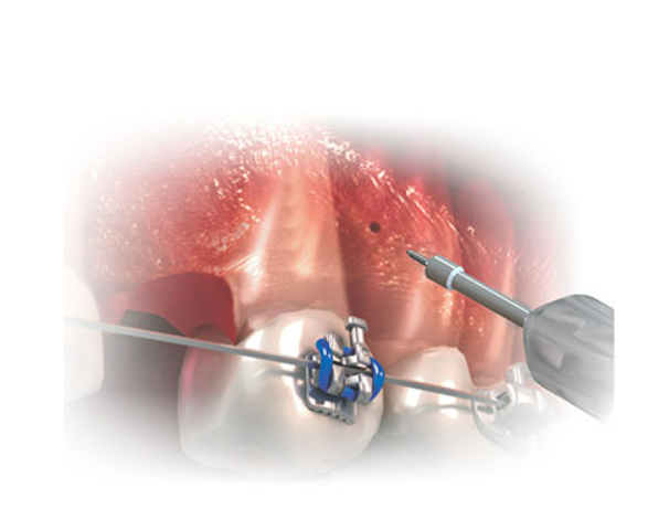 Hexagonal Key - Long & Short Stem