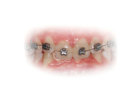 Archwire Superelastic "Ultra Light" NiTi Round Ø0,25mm (.010")