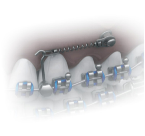 Spring Closed NiTi- Medium Force 200gf- Eyelets Ø1,60mm- 4 PCs