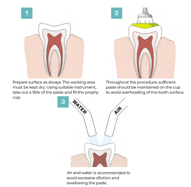 i-FASTE Tooth Surface Polishing Paste