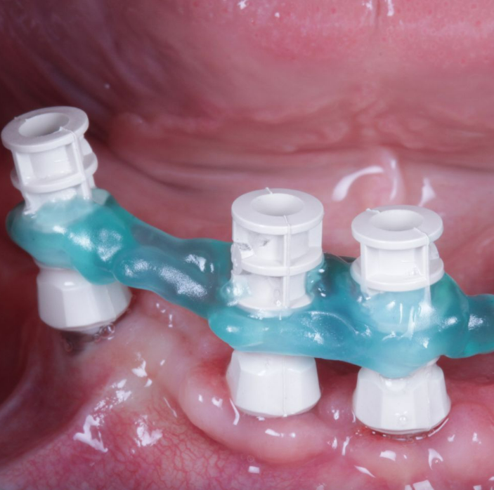 Resinlay Pattern Photo Gel (3g+ 3 Tips)