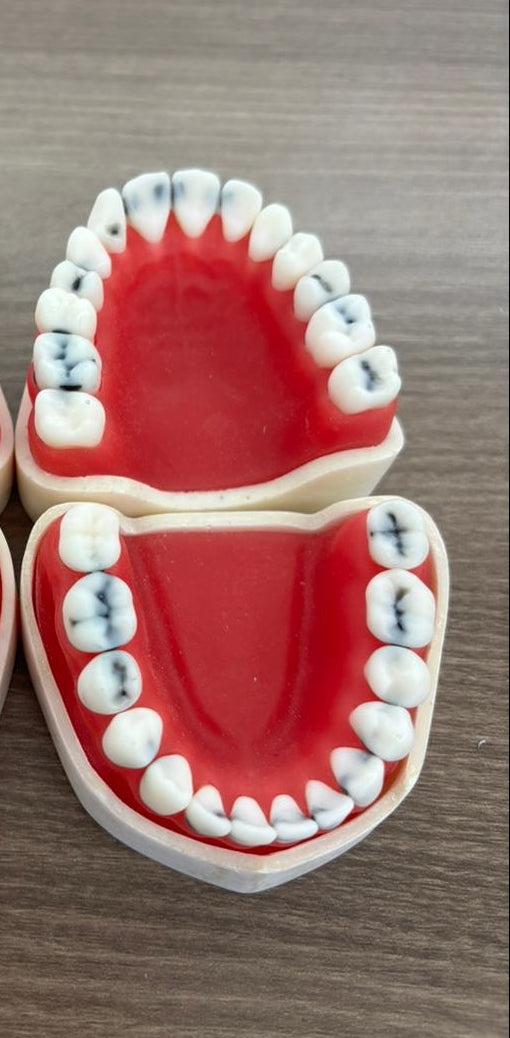 Full jaw dental caries model study- 28 teeth