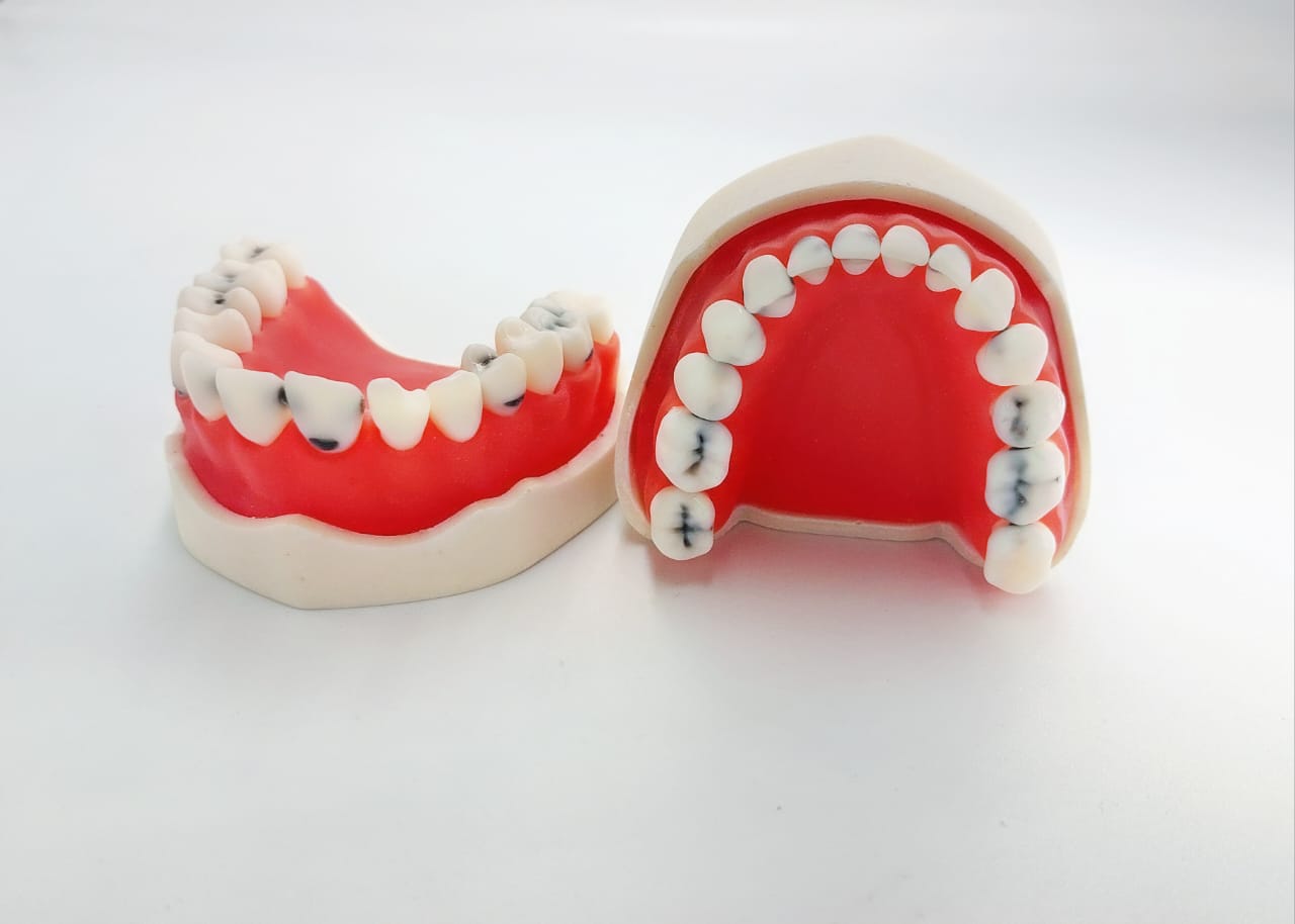 Full jaw dental caries model study- 28 teeth